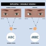 la diplopia como afecta la vision